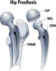 medical instrumentation hip teachengineering lesson prosthesis implant artificial duk